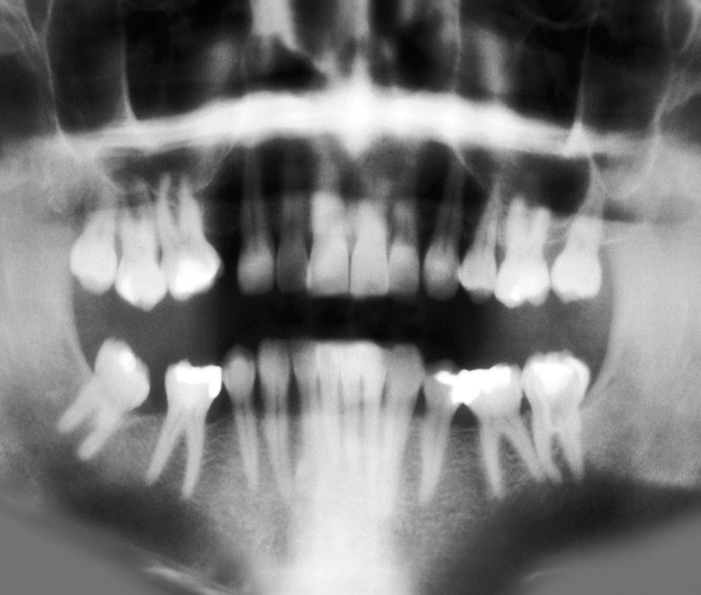 X-Ray view of teeth